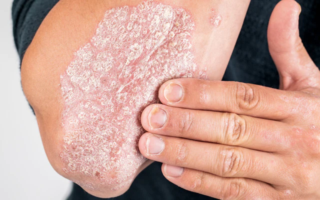 psoriasis